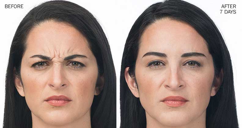 Before and after Botox injections
