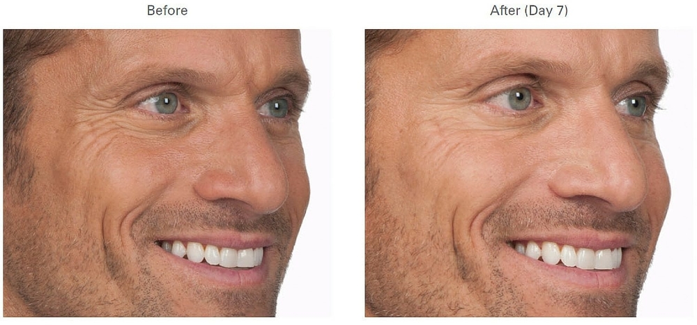 botox wrinkles sweating boise