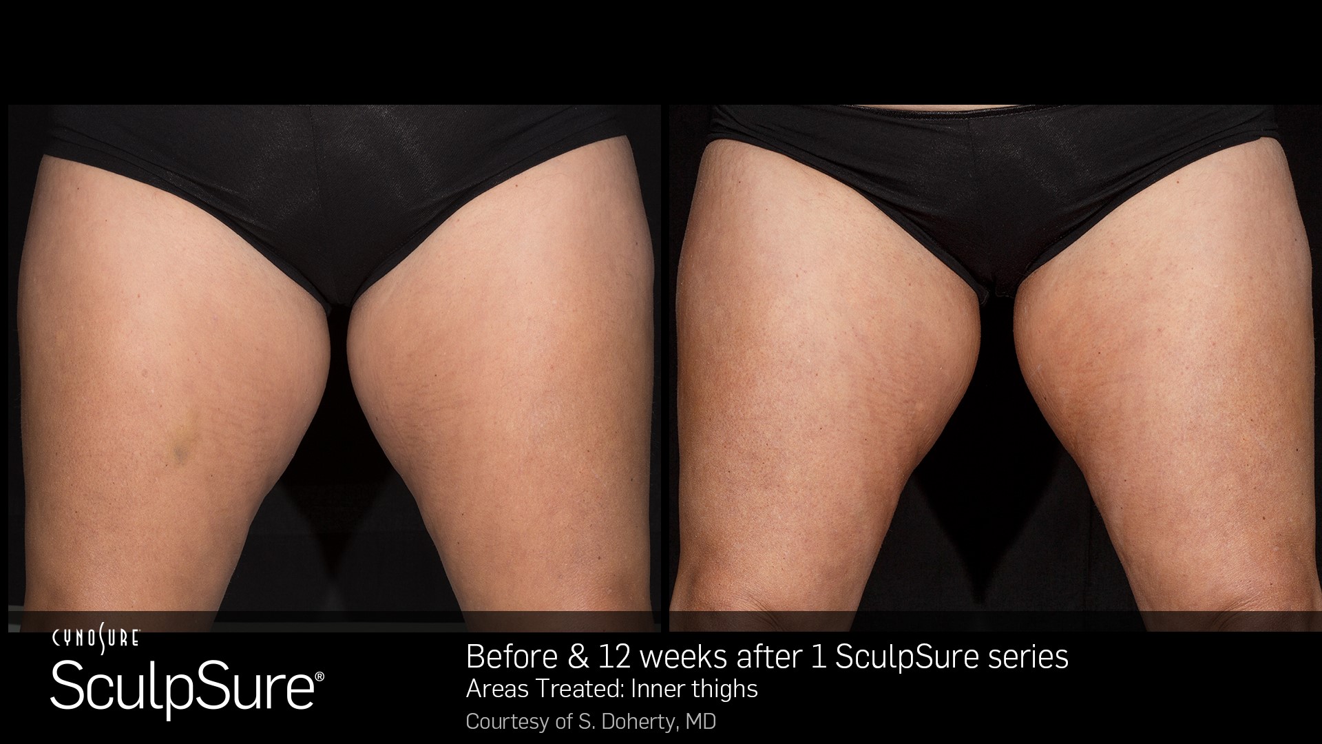 SculpSure before and after results
