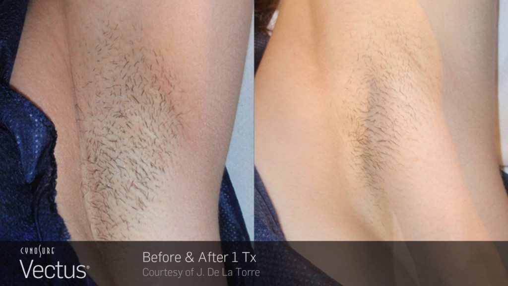 Before and after hair removal results