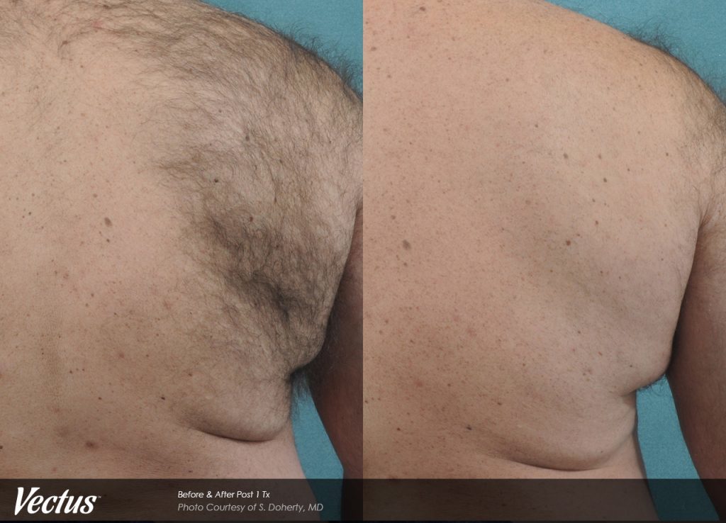 Before and after Vectus Hair Removal
