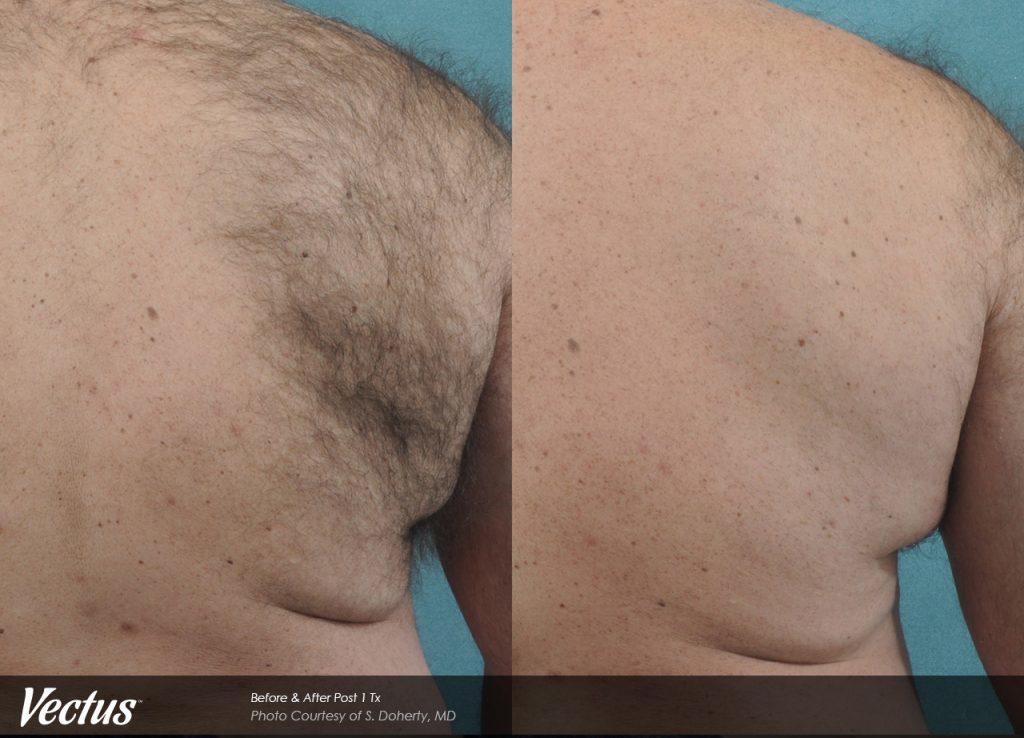 Before and after hair removal results