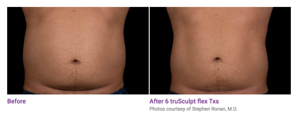 Before and after truSculpt results