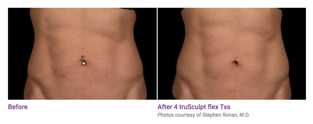 Before and after truSculpt results