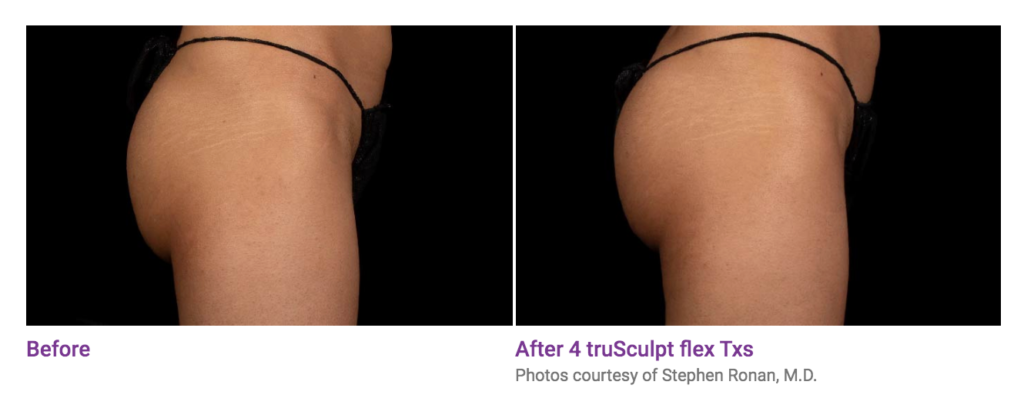 Before and after truSculpt results