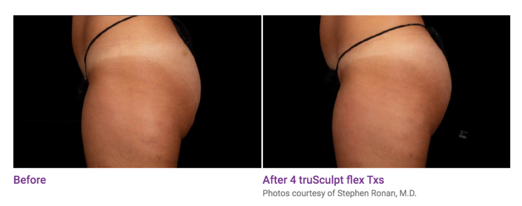 Before and after truSculpt results