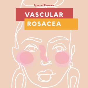 Vascular Rosacea