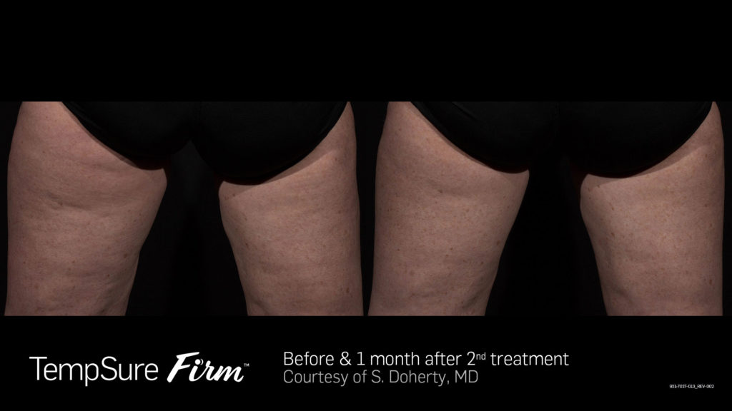Before and after Firm results