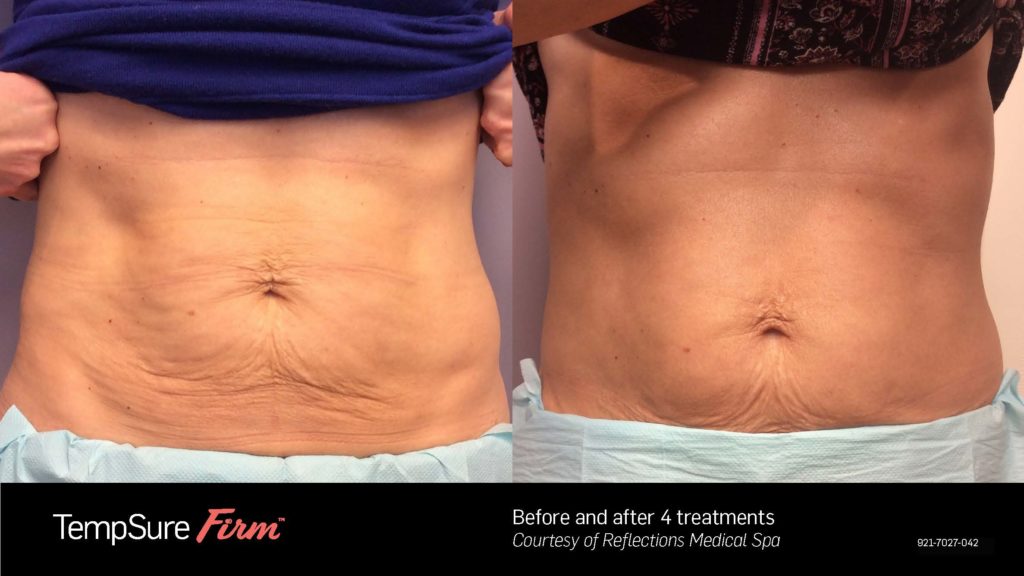 Before and after Firm results