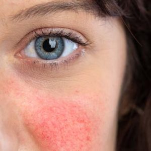 Rosacea Treatments
