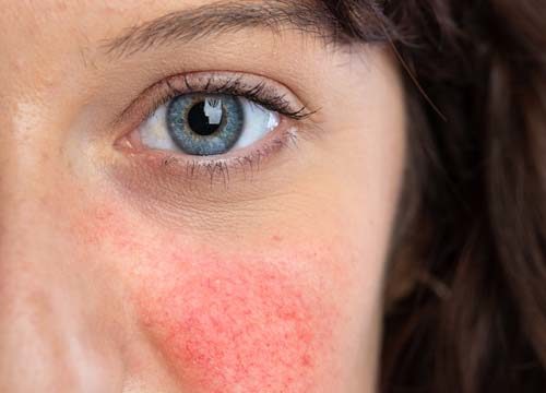 Woman with rosacea on her cheek
