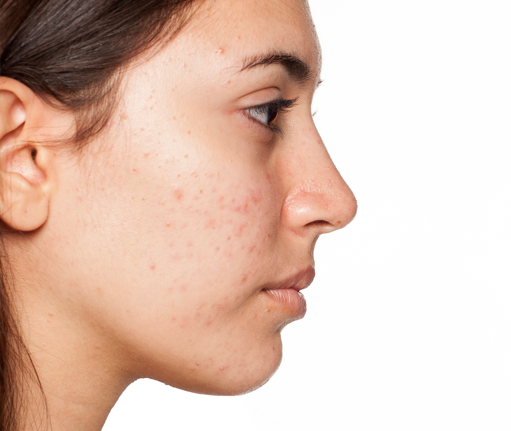 Woman's face with acne