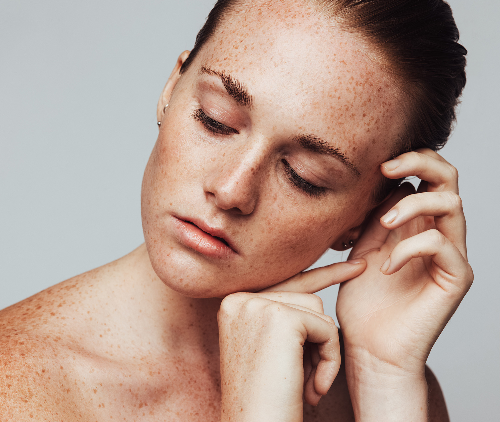 Close-up on hyperpigmentation on a woman's face