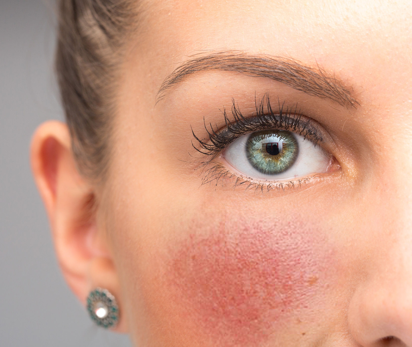 Rosacea on a woman's cheek