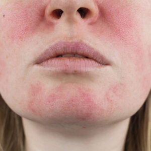 How to Overcome Rosacea Naturally: Commonly Overlooked Causes