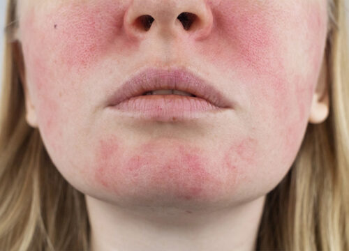 Rosacea