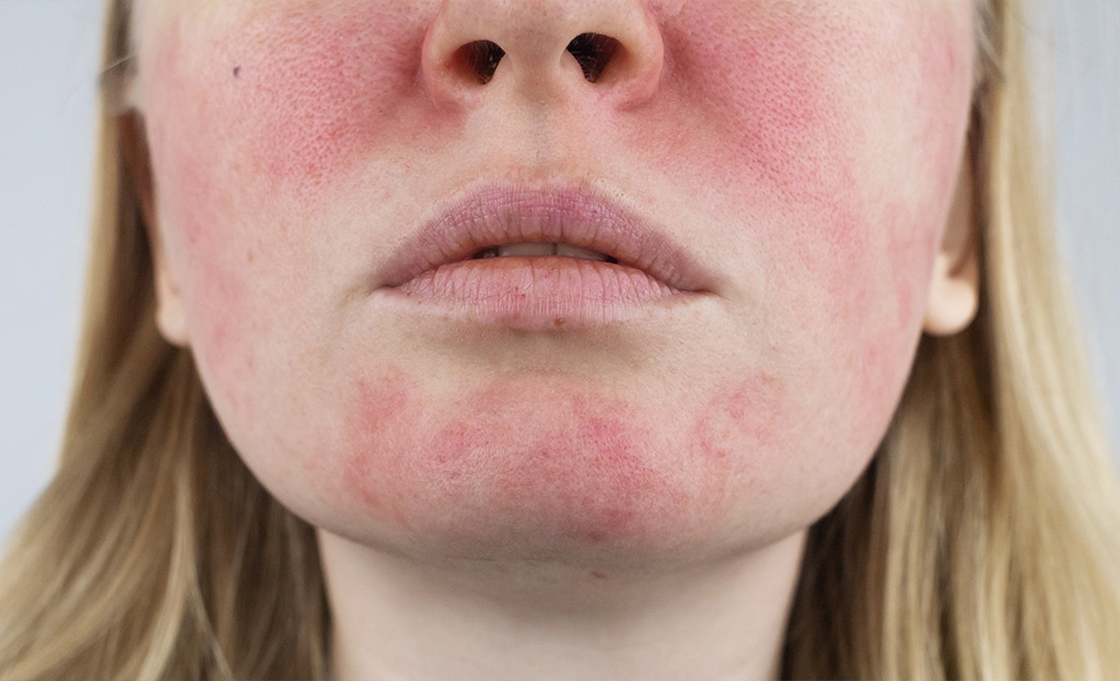 How to Overcome Rosacea Naturally: Commonly Overlooked Causes